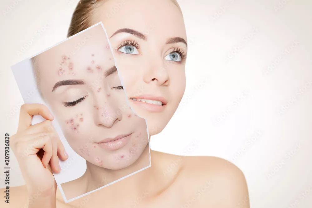 Fototapeta portret kobiety z czystą skórą portret z wypryskami skóry